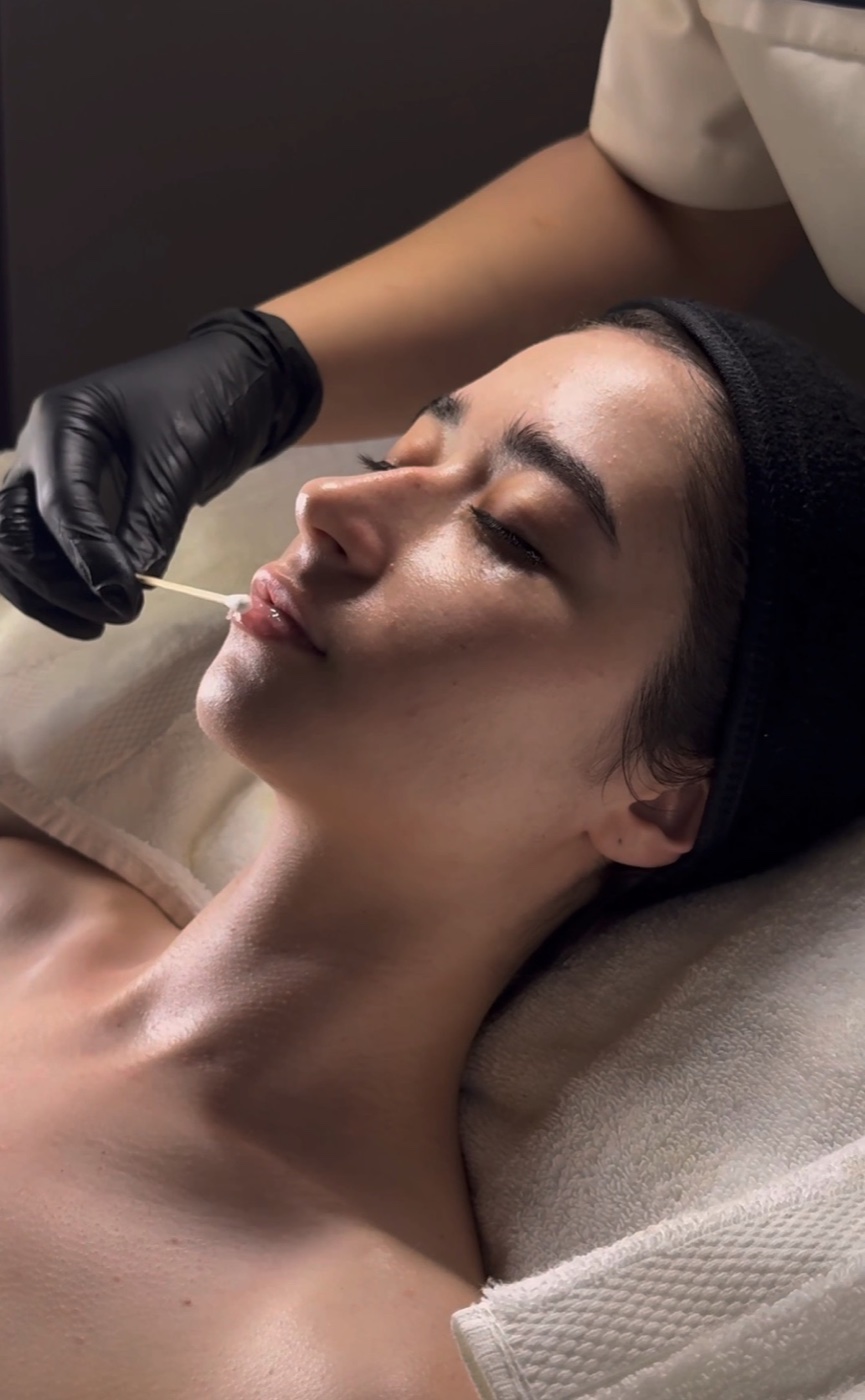 Lip treatment at Solace Wellness Aesthetics Fort Myers medspa