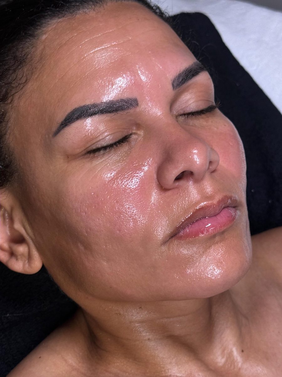 Patient skin result immediately after Pro-MicroPeel chemical peel treatment at Solace Wellness Aesthetics Fort Myers FL
